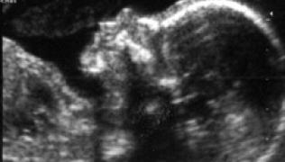 Fetal medicine scan