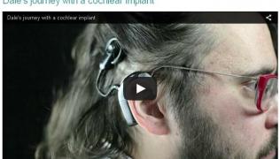 20160914-cochlear-implants-image