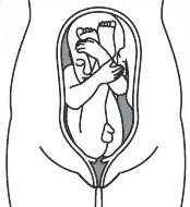 An image of a baby in the extended or frank breech position, bottom down and holding its legs up to its head