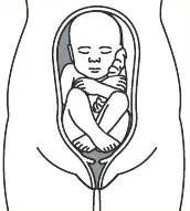 An image of a baby in the flexed breech position. The baby is bottom first, with thighs against the chest and the knees bent
