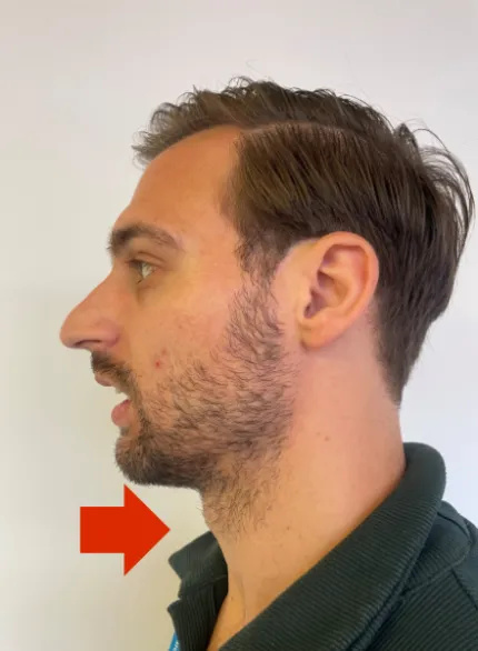 Photo of a man in an upright posture with his mouth slightly open. He is moving his chin backwards towards the resting position.
