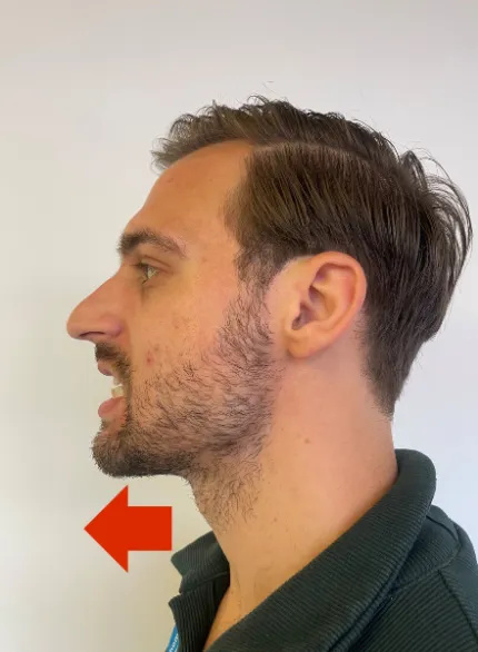 Photo of a man in an upright posture with his mouth slightly open. He is poking his chin forwards, so that the bottom jaw overlaps with the top jaw.