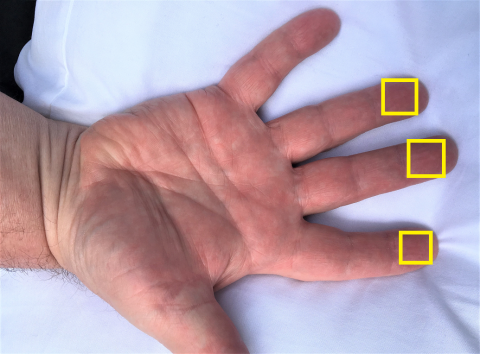 Photo of an open hand with yellow boxes on the first 3 fingertips showing possible places to take a blood sample