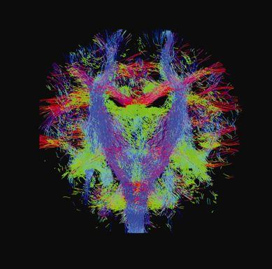 Nerve fibre tracts in a newborn baby's brain, coloured according to which direction the nerve run