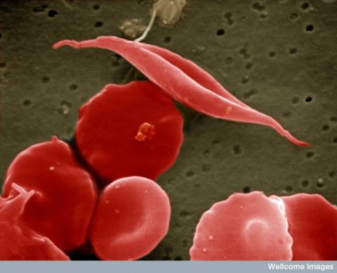 Sickled and other red blood cells